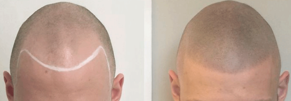 What is micro hair pigmentation or scalp micropigmentation? - 2pass Clinic